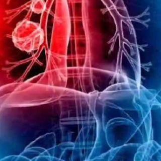 Mesotelioma Mesotelioma