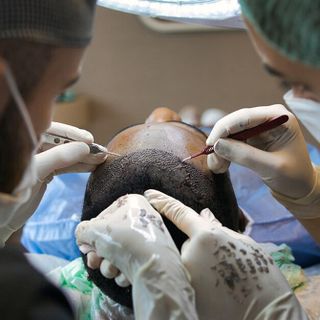 Le Migliori Cliniche per il Trapianto di Capelli in Turchia da Conoscere nel 2025