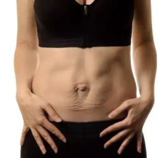 Diastasi dei retti: cause, sintomi e trattamenti efficaci