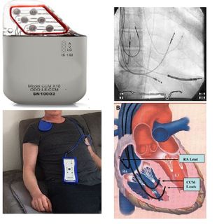 Ospedale Mauriziano, per la prima volta in Italia impiantato un dispositivo per la Modulazione della Contrattilità Cardiaca
