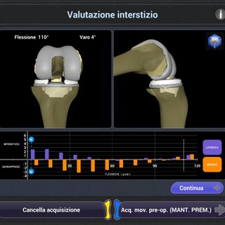 Cto, per la prima volta in Italia eseguito con un robot un impianto di protesi di ginocchio anatomica con risparmio dei crociati