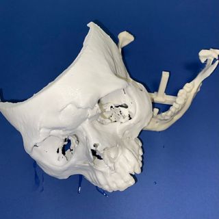 Un volto umano in 3D ricostruito in urgenza