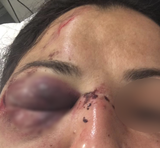L'attivista No Tav rimasta ferita