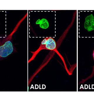 Interferenza a RNA: da Torino nuovo approccio terapeutico per la leucodistrofia
