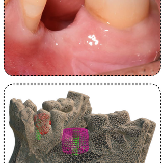 Problemi dentali? Da Beldent puoi provare una nuova tecnica di rigenerazione ossea che ti potrebbe davvero migliorare la vita!