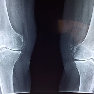 Beneficio della magnetoterapia per il trattamento dell'osteoartrosi e di altre malattie Cos'è l'artrosi?