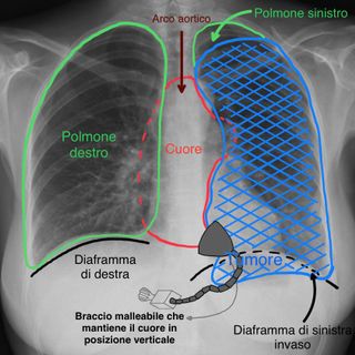 radiografia ai polmoni