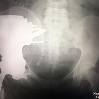 Al Cto di Torino intervento chirurgico di ortopedici e ingegneri salva una donna affetta da rarissima forma di sarcoma osseo
