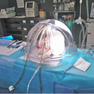 Un polmone pronto a essere trapiantato