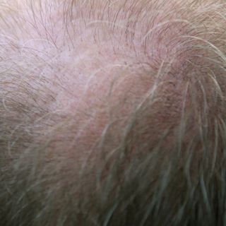 Trapianti di capelli: il miglior costo per un super risultato