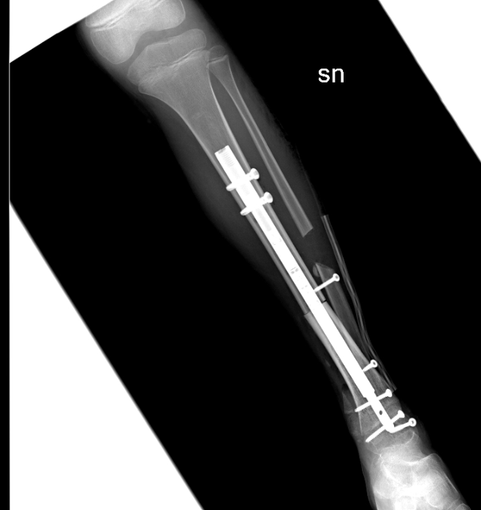 Prima volta al mondo: una bimba di 9 anni ha una nuova caviglia grazie all'osso di un donatore e un chiodo allungabile. E tornerà a camminare