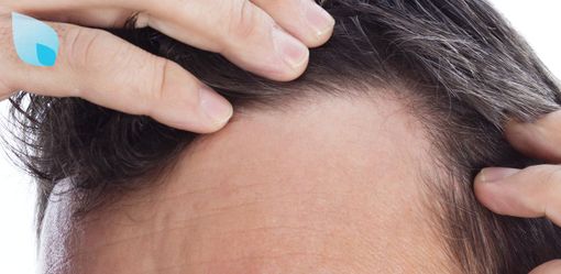 Alopecia, oggi si può agire concretamente