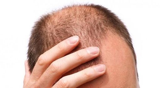 Oggi la calvizie si sconfigge all’estero