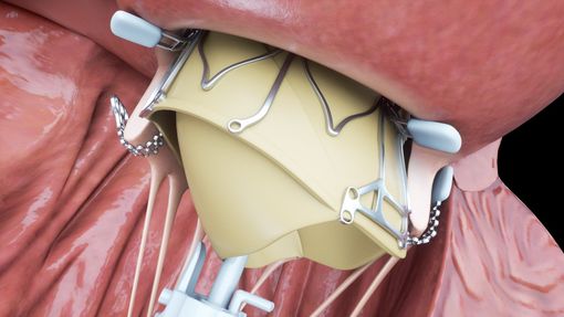 Orgoglio torinese: alle Molinette impiantata per la prima volta al mondo una protesi al cuore "speciale"