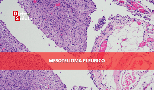 Amianto ad alta quota: causa pilota di condanna di ATITECH per risarcimento danni