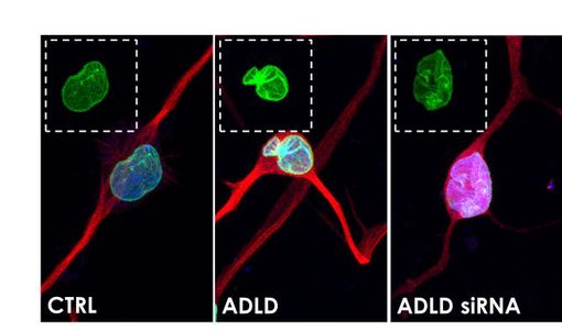 Interferenza a RNA: da Torino nuovo approccio terapeutico per la leucodistrofia Interferenza a RNA: da Torino nuovo approccio terapeutico per la leucodistrofia