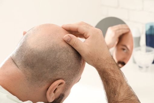 Diradamento capelli sul vertice, cosa fare quando avviene