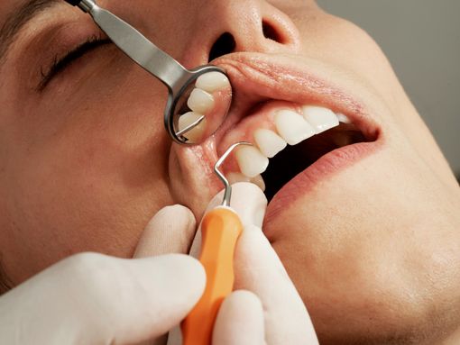 Faccette dentali sempre più richieste: il successo dell'odontoiatria estetica tra bellezza e vantaggi funzionali