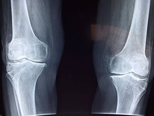 Beneficio della magnetoterapia per il trattamento dell'osteoartrosi e di altre malattie Cos'è l'artrosi?