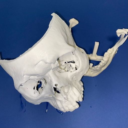 Un volto umano in 3D ricostruito in urgenza