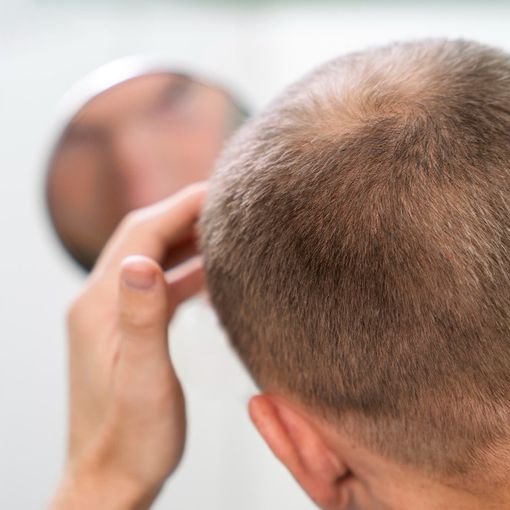 La Tua Guida Completa alle Patch Cutanee per la Crescita dei Capelli: Cosa Devi Sapere