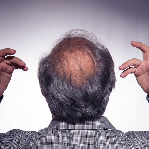 La Calvizie e l'Emotività: Il Trapianto di Capelli come Soluzione Ottimale
