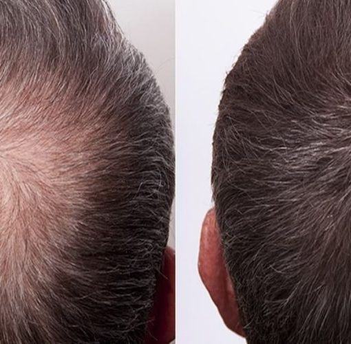 Diradamento Capelli, cause e come si risolve