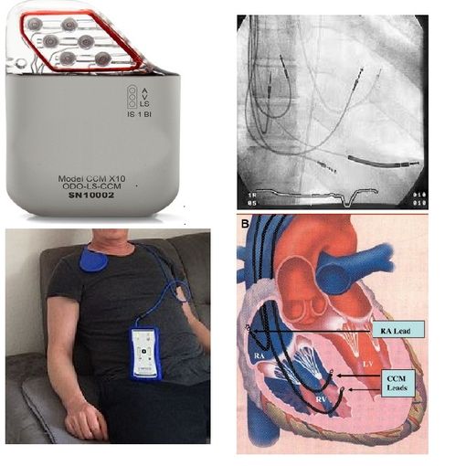 Ospedale Mauriziano, per la prima volta in Italia impiantato un dispositivo per la Modulazione della Contrattilità Cardiaca