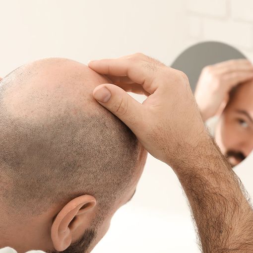 Diradamento capelli sul vertice, cosa fare quando avviene
