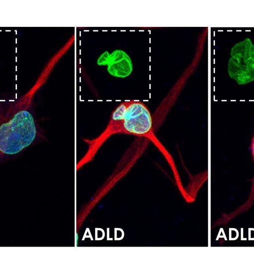 Interferenza a RNA: da Torino nuovo approccio terapeutico per la leucodistrofia
