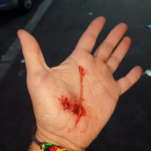 mano ferita mano ferita