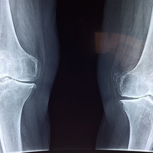 Beneficio della magnetoterapia per il trattamento dell'osteoartrosi e di altre malattie Cos'è l'artrosi?