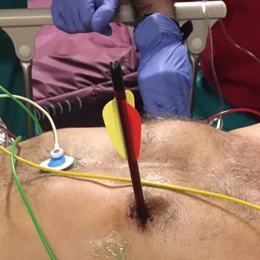 Arriva in ospedale con una freccia piantata nel cuore: salvato alle Molinette con un intervento senza precedenti