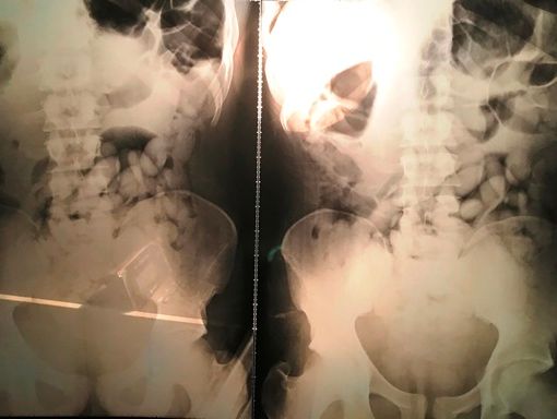 Ovuli ingeriti da un body stuffer per sottrarsi all'arresto