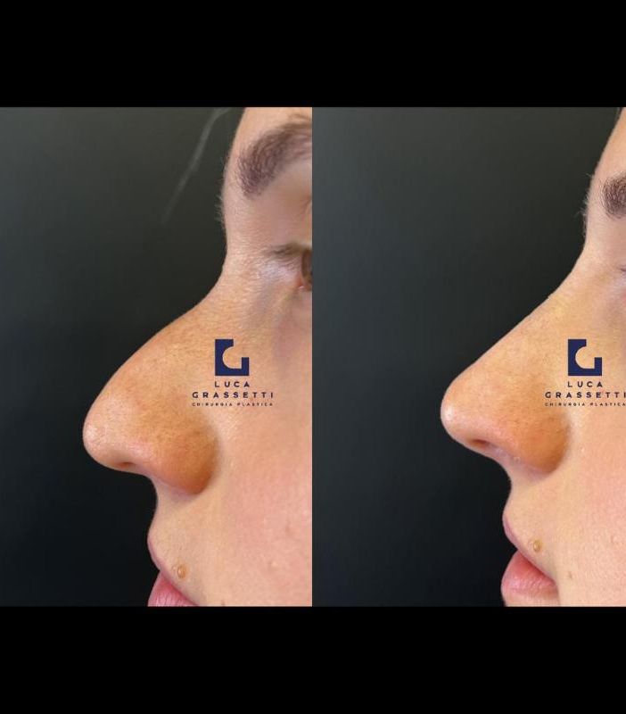 Cos’è il Rinofilling, anche detto Rino-Lipofilling?