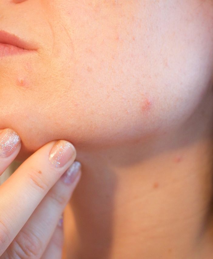 Acne e imperfezioni cutanee: cosa fare e a chi rivolgersi