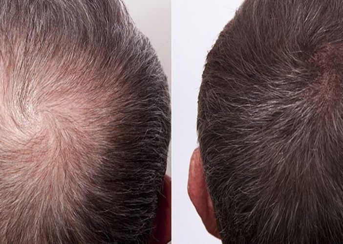Diradamento Capelli, cause e come si risolve