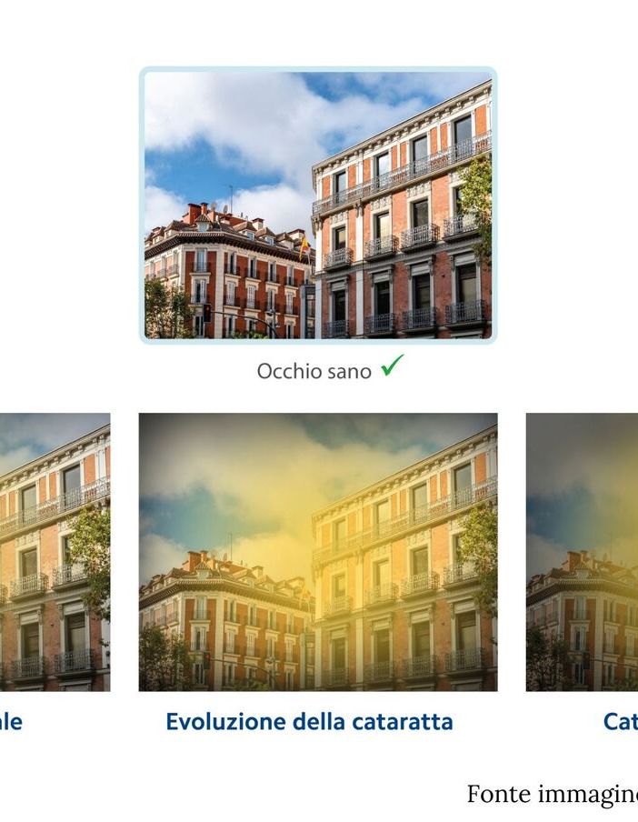 Fasi del post-operatorio dopo un'operazione di cataratta
