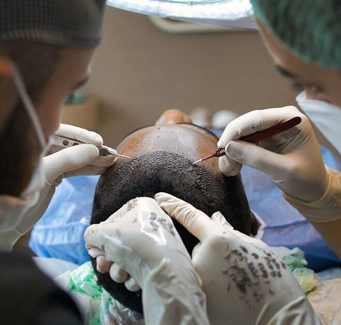 Le Migliori Cliniche per il Trapianto di Capelli in Turchia da Conoscere nel 2025