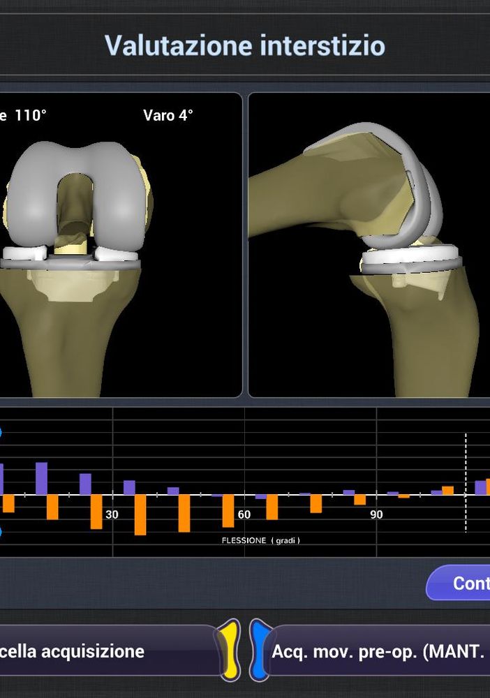 Cto, per la prima volta in Italia eseguito con un robot un impianto di protesi di ginocchio anatomica con risparmio dei crociati