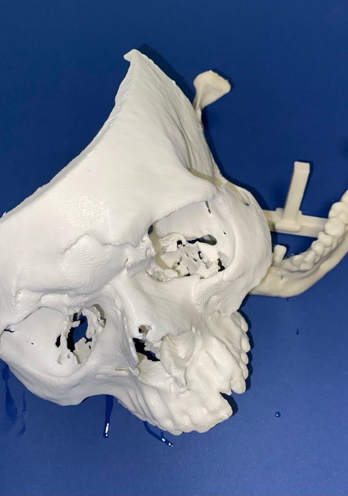 Un volto umano in 3D ricostruito in urgenza