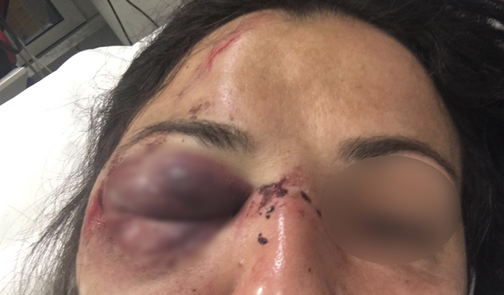 L'attivista No Tav rimasta ferita