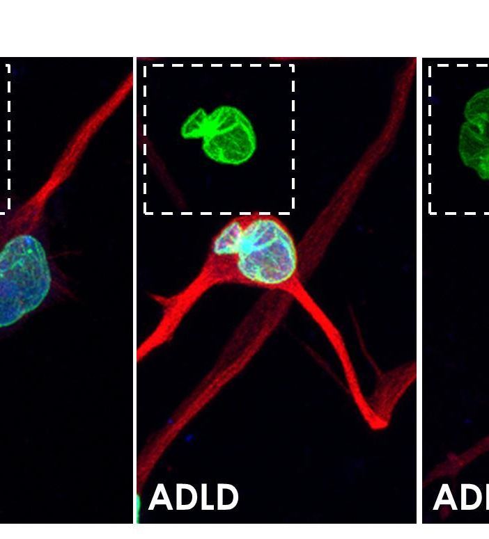 Interferenza a RNA: da Torino nuovo approccio terapeutico per la leucodistrofia