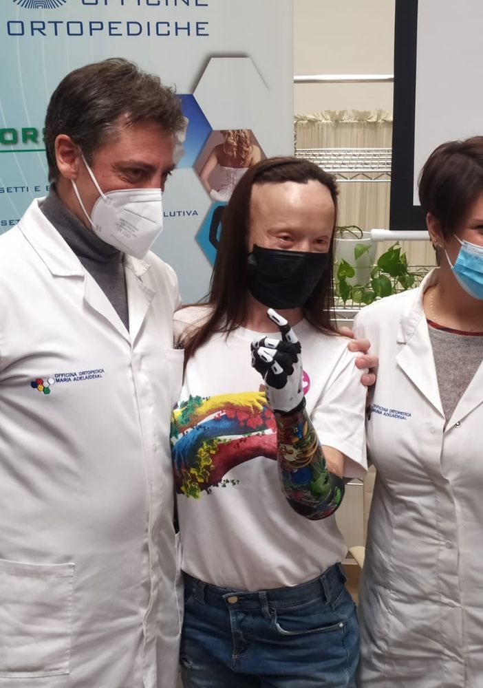 Valentina Pitzalis e la mano bionica