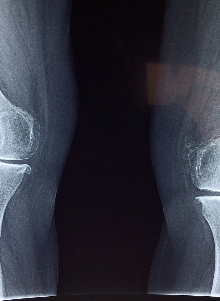 Beneficio della magnetoterapia per il trattamento dell'osteoartrosi e di altre malattie Cos'è l'artrosi?