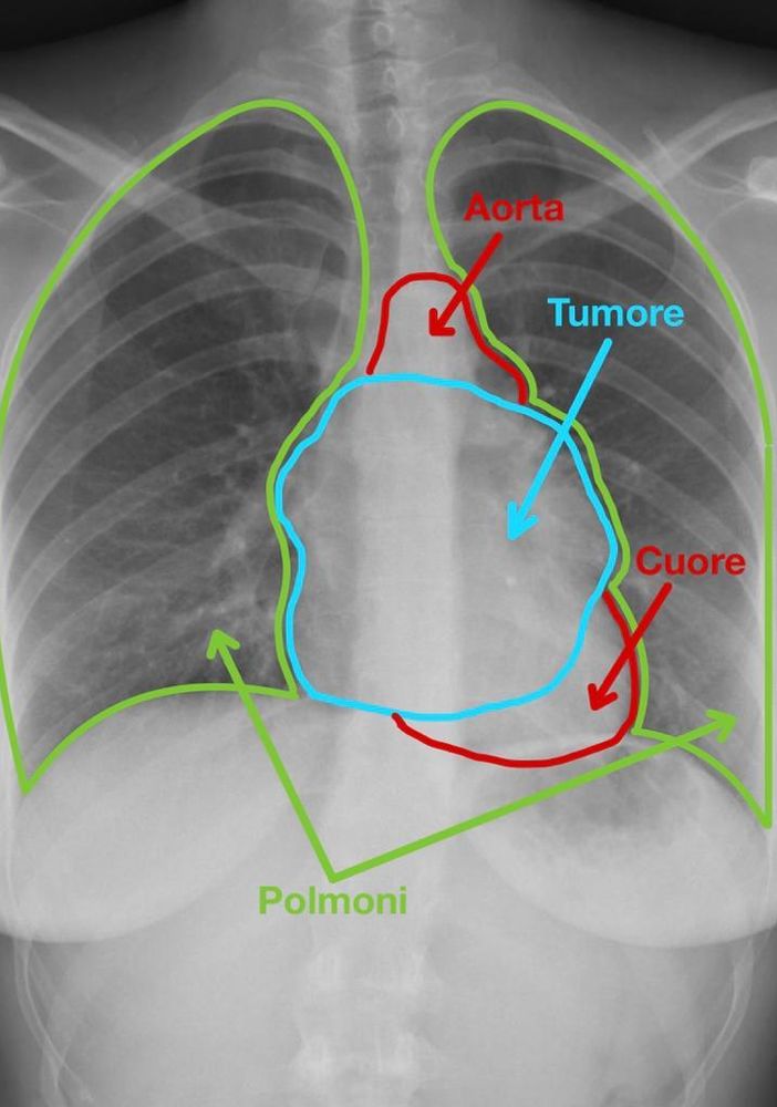 Radiografia della donna operata di tumore alle Molinette
