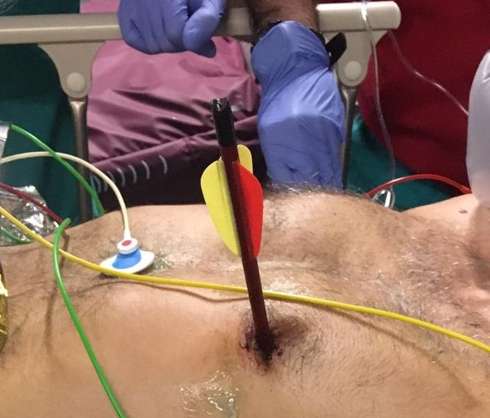 Arriva in ospedale con una freccia piantata nel cuore: salvato alle Molinette con un intervento senza precedenti