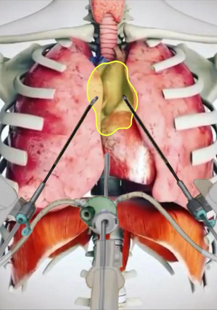 Intervento innovativo alle Molinette: salvato un uomo con una massa tumorale di 10x10 cm sopra il cuore