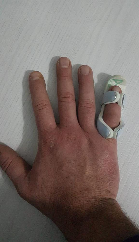 mano ferita