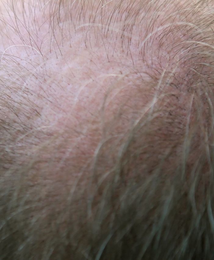 Trapianti di capelli: il miglior costo per un super risultato